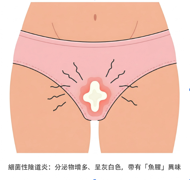 細菌性陰道炎 (Bacterial Vaginosis)
